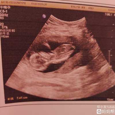 三个月胎儿图彩超图片(三个月胎儿图彩超图片 男孩子) 第1张 三个月胎儿图彩超图片(三个月胎儿图彩超图片 男孩子) 第1张