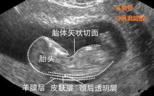 胎儿仰头(胎儿仰头对nt影响) 第2张 胎儿仰头(胎儿仰头对nt影响) 第2张