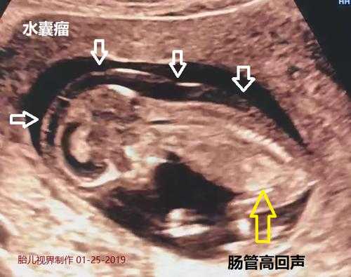 胎儿长肿瘤(胎儿长肿瘤的原因) 第1张 胎儿长肿瘤(胎儿长肿瘤的原因) 第1张