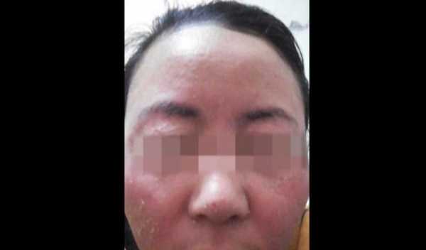 胎儿汞中毒（胎儿汞中毒）  第1张