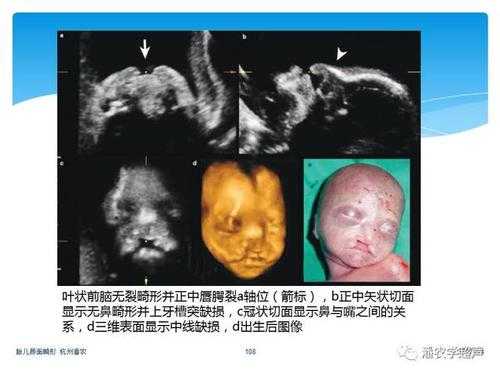 胎儿上唇裂（胎儿上唇裂伴腭裂原因）  第2张