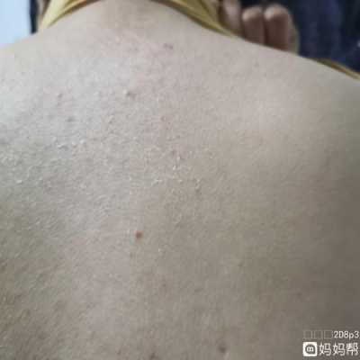 孕期后背痒(孕期后背痒怎么回事) 第2张 孕期后背痒(孕期后背痒怎么回事) 第2张
