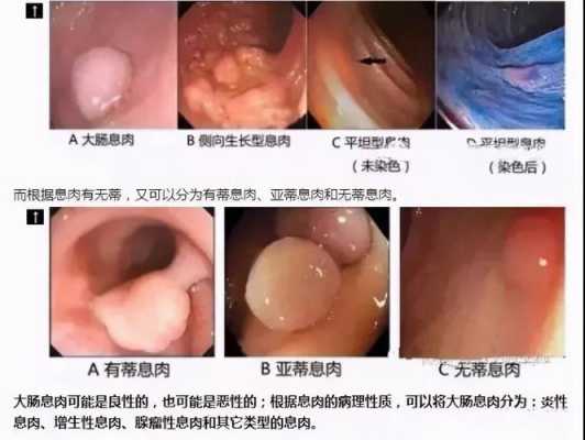 孕期息肉大(孕期息肉大便用力出血) 第2张 孕期息肉大(孕期息肉大便用力出血) 第2张