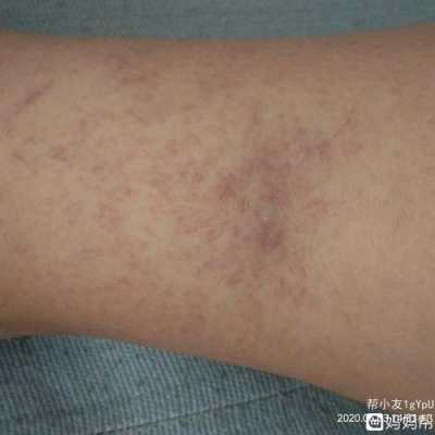 孕期血管疼（孕妇血管疼）  第2张