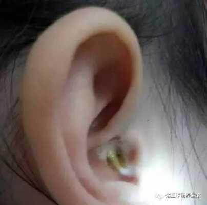孕妇耳朵发炎影响胎儿(孕妇耳朵发炎影响胎儿) 第2张 孕妇耳朵发炎影响胎儿(孕妇耳朵发炎影响胎儿) 第2张