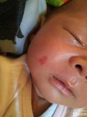 孕妇怎样防止孩子有胎记,如何预防胎儿长胎记在脸上 第2张 孕妇怎样防止孩子有胎记,如何预防胎儿长胎记在脸上 第2张