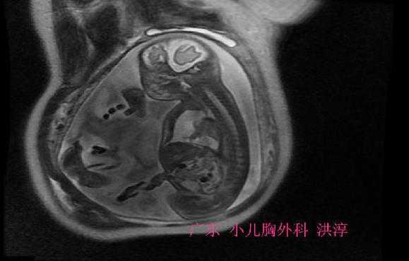 胎儿心脏积液对胎儿有影响吗,孕妇积水对胎儿的影响有哪些  第1张