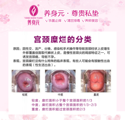 孕期阴道囊肿(孕期有囊肿怎么办) 第2张 孕期阴道囊肿(孕期有囊肿怎么办) 第2张