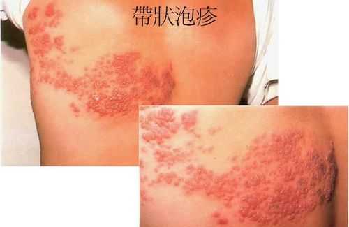 孕妇起疱疹影响胎儿吗(孕妇起疱疹影响胎儿吗图片) 第2张 孕妇起疱疹影响胎儿吗(孕妇起疱疹影响胎儿吗图片) 第2张