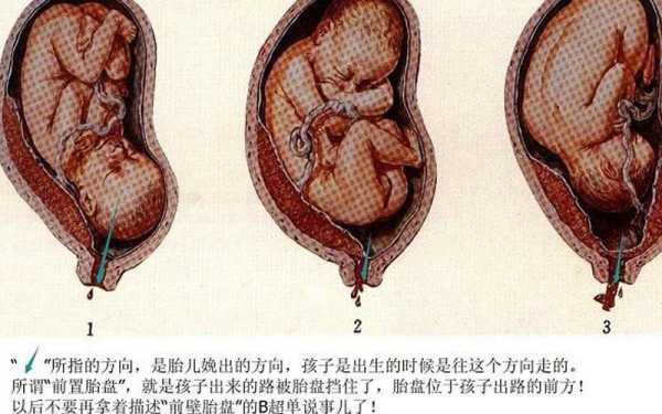 胎位不正对胎儿有影响吗（胎位不正对胎儿有影响吗视频）  第2张