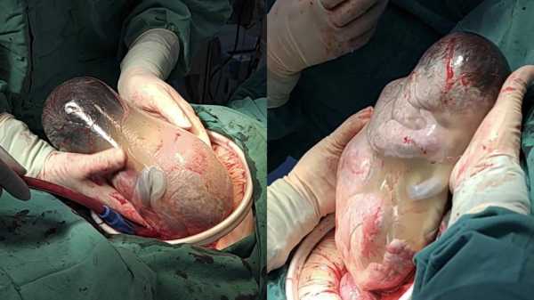 怀孕32周提前剖腹产宝宝能存活吗?我不知道应该要怎么办才好,32周的胎儿能存活吗? 第2张 怀孕32周提前剖腹产宝宝能存活吗?我不知道应该要怎么办才好,32周的胎儿能存活吗? 第2张