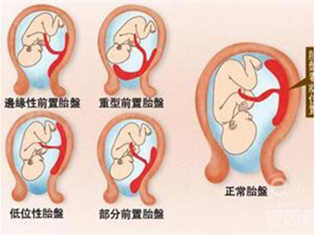 为什么胎盘里没有胎伢,胎儿是在胎盘里面吗还是子宫里面 第2张 为什么胎盘里没有胎伢,胎儿是在胎盘里面吗还是子宫里面 第2张