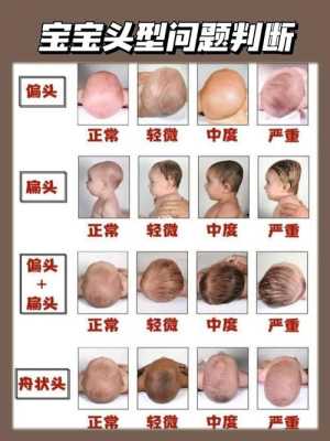 胎儿舟状头(一岁多的宝宝舟状头怎么办) 第1张 胎儿舟状头(一岁多的宝宝舟状头怎么办) 第1张