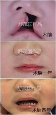 胎儿唇裂手术(胎儿唇裂手术多少钱) 第2张 胎儿唇裂手术(胎儿唇裂手术多少钱) 第2张