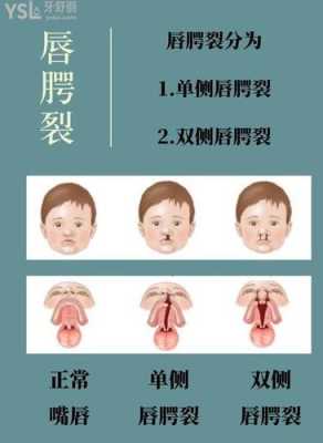 胎儿唇裂手术(胎儿唇裂手术多少钱) 第1张 胎儿唇裂手术(胎儿唇裂手术多少钱) 第1张