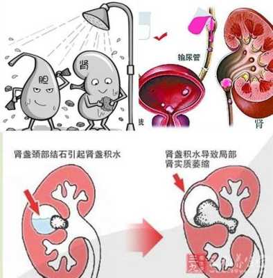 胎儿中积水（怀孕宝宝肾积水是什么原因）  第3张
