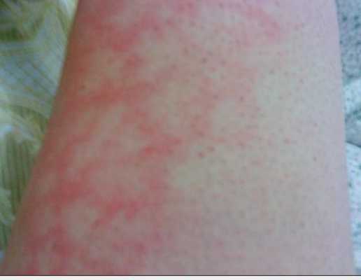 孕期大腿内侧痛(孕期大腿内侧红了一块,又痛是怎么回事) 第1张 孕期大腿内侧痛(孕期大腿内侧红了一块,又痛是怎么回事) 第1张
