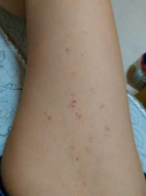 孕期大腿内侧痛(孕期大腿内侧红了一块,又痛是怎么回事) 第2张 孕期大腿内侧痛(孕期大腿内侧红了一块,又痛是怎么回事) 第2张