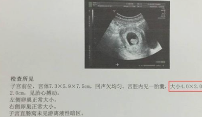 38周B超,知道双顶径,骨股长,肱骨长,如何预测宝宝的体重,怎么预测胎儿的体重 第3张 38周B超,知道双顶径,骨股长,肱骨长,如何预测宝宝的体重,怎么预测胎儿的体重 第3张