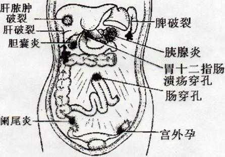 孕期腹膜炎（孕期腹膜炎）  第2张