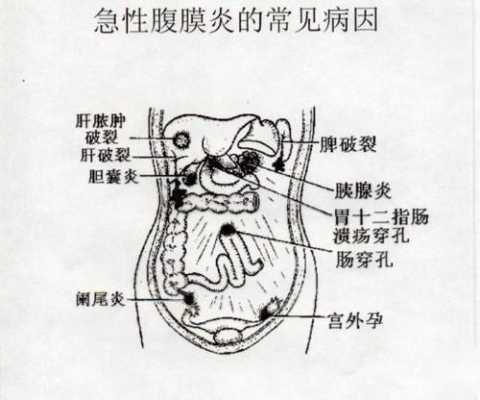 孕期腹膜炎（孕期腹膜炎）  第1张