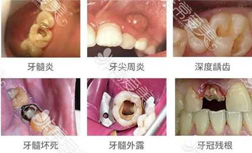孕期牙齿坏了怎么办,孕期根管治疗危害 第2张 孕期牙齿坏了怎么办,孕期根管治疗危害 第2张