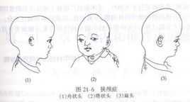 胎儿小头畸形的诊断标准是怎样的?怀孕8个月多,要注意什么呢,怎么确认胎儿小头畸形图片 第1张 胎儿小头畸形的诊断标准是怎样的?怀孕8个月多,要注意什么呢,怎么确认胎儿小头畸形图片 第1张