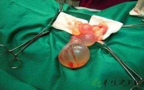 怀孕期有囊肿(孕期卵巢囊肿怎么办) 第2张 怀孕期有囊肿(孕期卵巢囊肿怎么办) 第2张