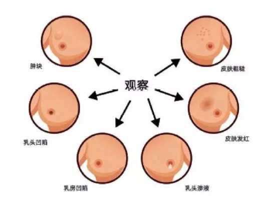 孕期乳腺纤维瘤(有乳腺纤维瘤可以怀孕吗) 第2张 孕期乳腺纤维瘤(有乳腺纤维瘤可以怀孕吗) 第2张
