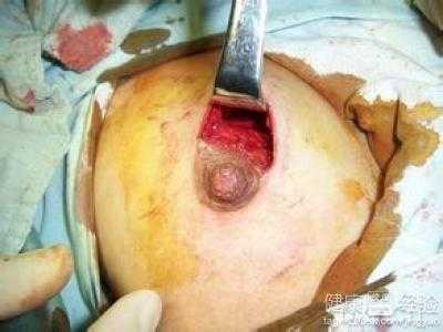 孕期乳腺纤维瘤(有乳腺纤维瘤可以怀孕吗) 第1张 孕期乳腺纤维瘤(有乳腺纤维瘤可以怀孕吗) 第1张