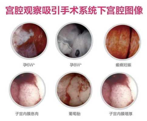 孕期怎么确定宫腔感染(宫腔内感染怎么治疗) 第2张 孕期怎么确定宫腔感染(宫腔内感染怎么治疗) 第2张