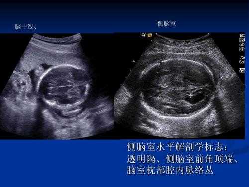 胎儿双侧脑室脉络丛内均见无回声怎么回事,胎儿双侧脉络丛是哪里 第2张 胎儿双侧脑室脉络丛内均见无回声怎么回事,胎儿双侧脉络丛是哪里 第2张