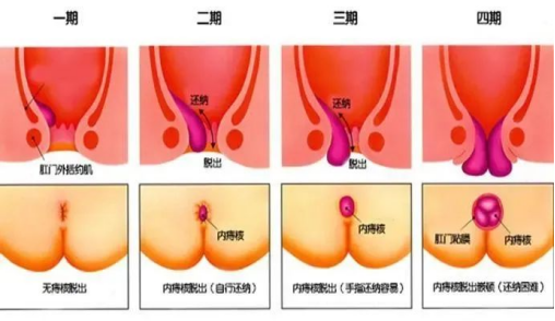 孕期痔疮很大脱出很疼(孕期痔疮很大脱出很疼怎么办) 第2张 孕期痔疮很大脱出很疼(孕期痔疮很大脱出很疼怎么办) 第2张