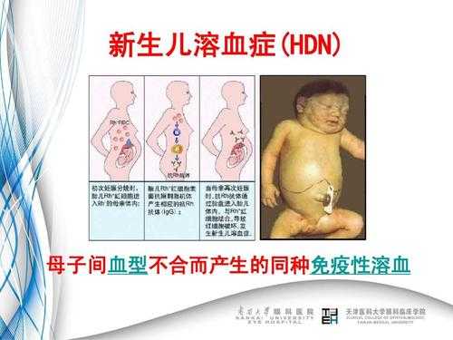 胎儿融血(abo溶血对胎儿发育有影响吗) 第1张 胎儿融血(abo溶血对胎儿发育有影响吗) 第1张