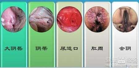 孕期尖锐湿疣怎么治疗(孕妇尖锐疣湿怎么治疗) 第2张 孕期尖锐湿疣怎么治疗(孕妇尖锐疣湿怎么治疗) 第2张
