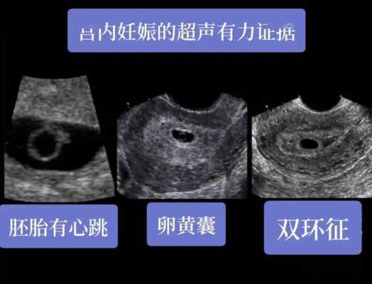 胎囊与胎儿(孕囊回声是什么意思) 第1张 胎囊与胎儿(孕囊回声是什么意思) 第1张