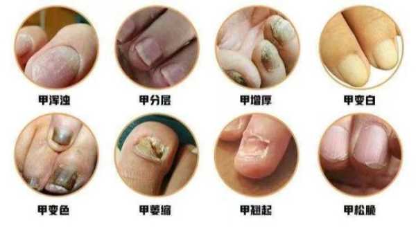 怀孕期间可以治疗灰指甲吗（怀孕期间可以治疗灰指甲吗有影响吗）  第2张