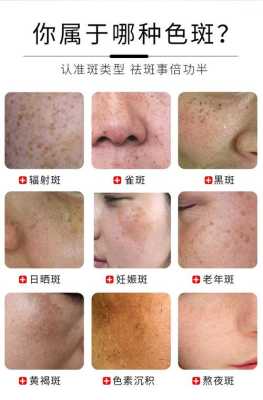 孕期雀斑（妊娠斑如何治疗）  第1张