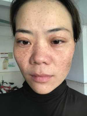 孕期雀斑（妊娠斑如何治疗）  第3张