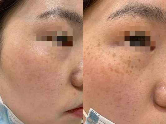 孕期雀斑（妊娠斑如何治疗）  第2张
