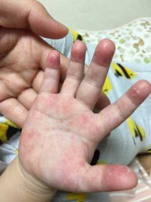 一岁三个月宝宝十个手指起皮是怎么回事,胎儿缺手是什么原因 第1张 一岁三个月宝宝十个手指起皮是怎么回事,胎儿缺手是什么原因 第1张