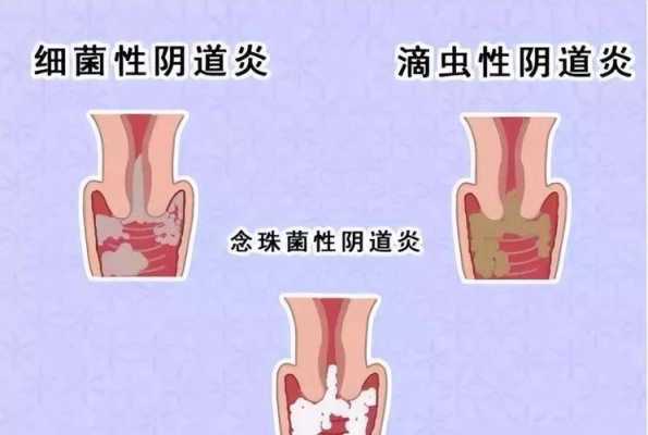 孕期搔痒(怀孕后外阴瘙痒咋回事?怎么办) 第2张 孕期搔痒(怀孕后外阴瘙痒咋回事?怎么办) 第2张