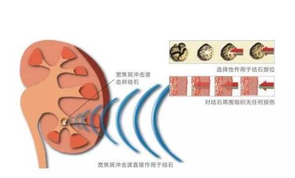 孕期碎石(孕期碎石对胎儿有影响吗) 第1张 孕期碎石(孕期碎石对胎儿有影响吗) 第1张
