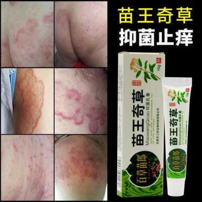 孕期股藓(孕期股藓可以擦什么) 第1张 孕期股藓(孕期股藓可以擦什么) 第1张