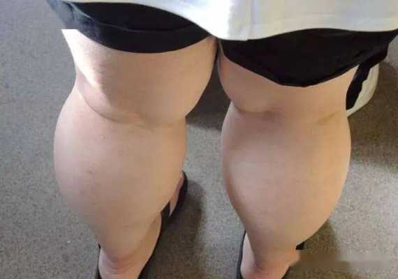 孕期腿长胖（婴儿腿一边瘦一边胖）  第2张