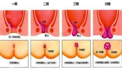 孕期痔疮脱出(孕期痔疮脱出严重肿大疼痛怎么办) 第2张 孕期痔疮脱出(孕期痔疮脱出严重肿大疼痛怎么办) 第2张