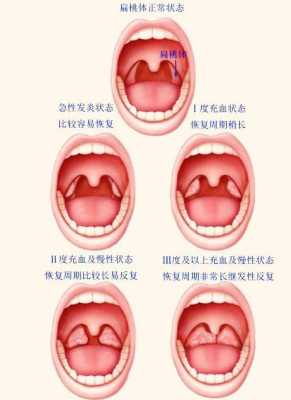 孕妇扁桃体发炎对胎儿（孕妇扁桃体发炎对胎儿有影响吗）  第1张