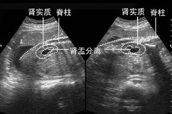 胎儿双肾盂未见明显分离怎么回事,胎儿肾盂无分离是什么意思是男孩女孩呢 第1张 胎儿双肾盂未见明显分离怎么回事,胎儿肾盂无分离是什么意思是男孩女孩呢 第1张