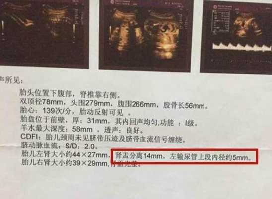 胎儿双肾盂未见明显分离怎么回事,胎儿肾盂无分离是什么意思是男孩女孩呢 第2张 胎儿双肾盂未见明显分离怎么回事,胎儿肾盂无分离是什么意思是男孩女孩呢 第2张