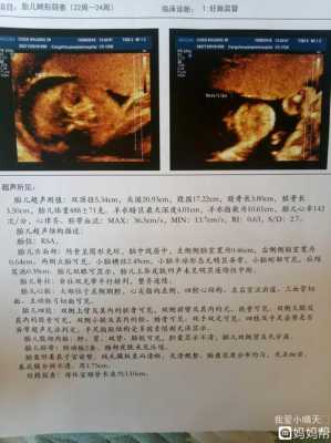 胎儿双肾盂未见明显分离怎么回事,胎儿肾盂无分离是什么意思是男孩女孩呢 第3张 胎儿双肾盂未见明显分离怎么回事,胎儿肾盂无分离是什么意思是男孩女孩呢 第3张
